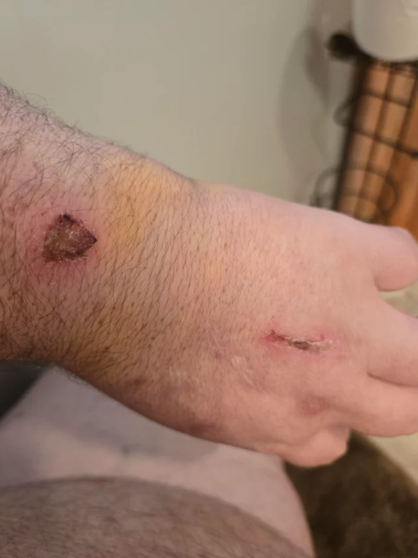 Injury from not wearing welding gloves