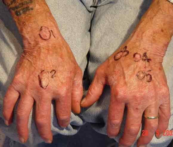 Injuries from not wearing welding gloves