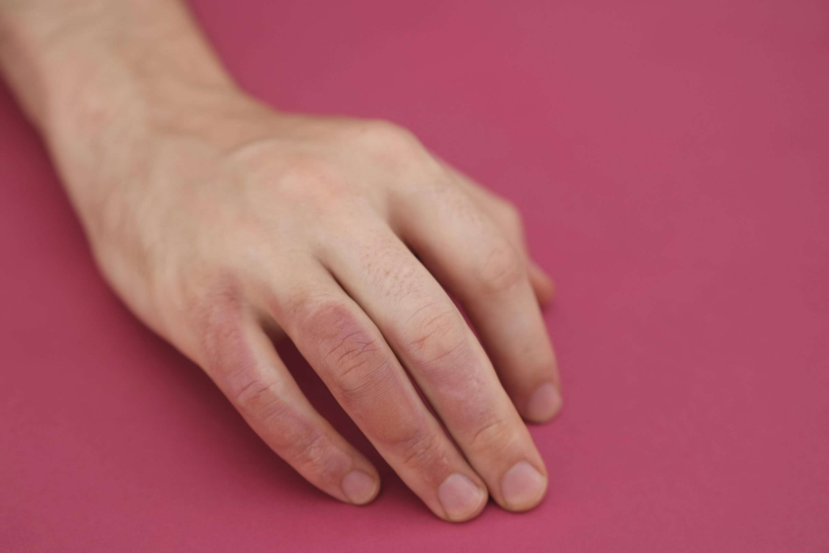 Injury from contact with high temperatures without wearing welding gloves